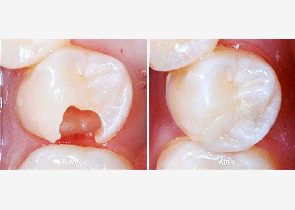Fillings And Restoration