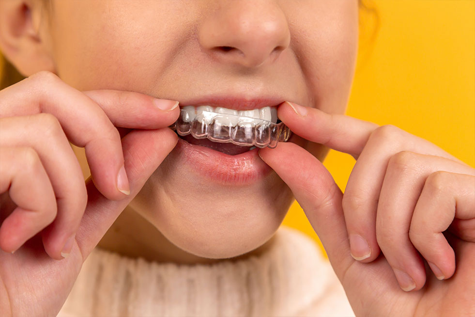dental-crowns
