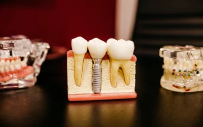 Different Types Of Dental Crowns And Why They Are Important