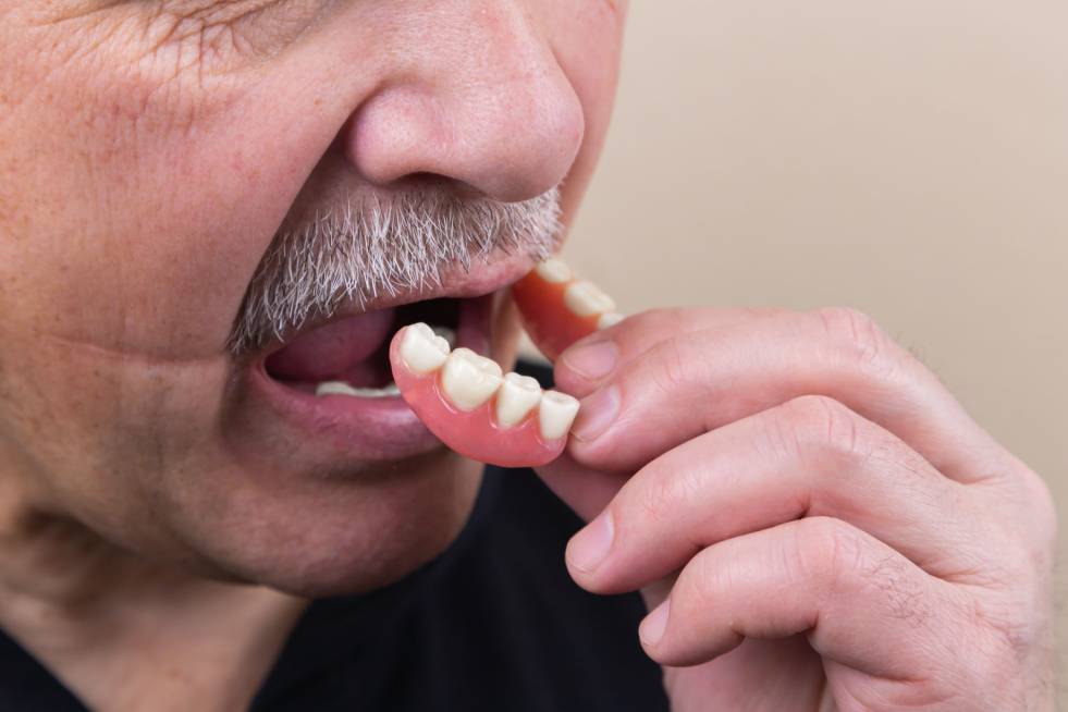 Dental Implants in India and Implant Supported Dentures