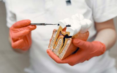 7 Signs You May Need a Root Canal Treatment