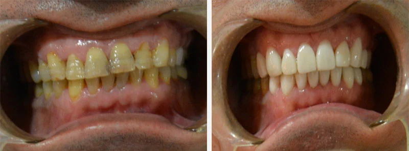 CERAMIC VENEERS