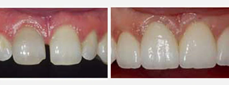 DIASTEMA CLOSURE