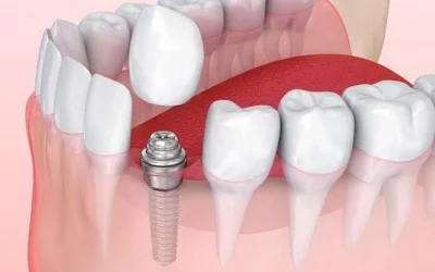 How Long Do Dental Implants Last?