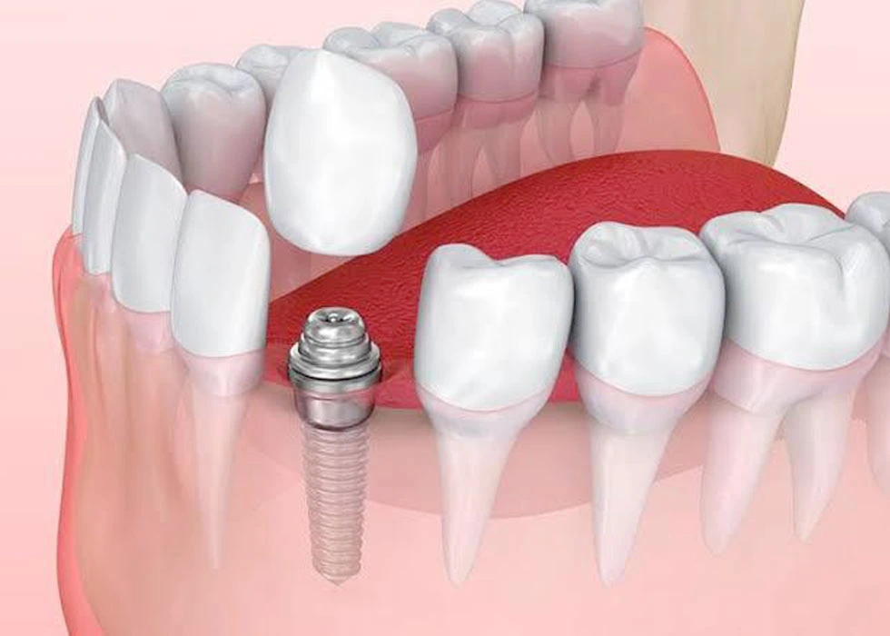 Dental Implants