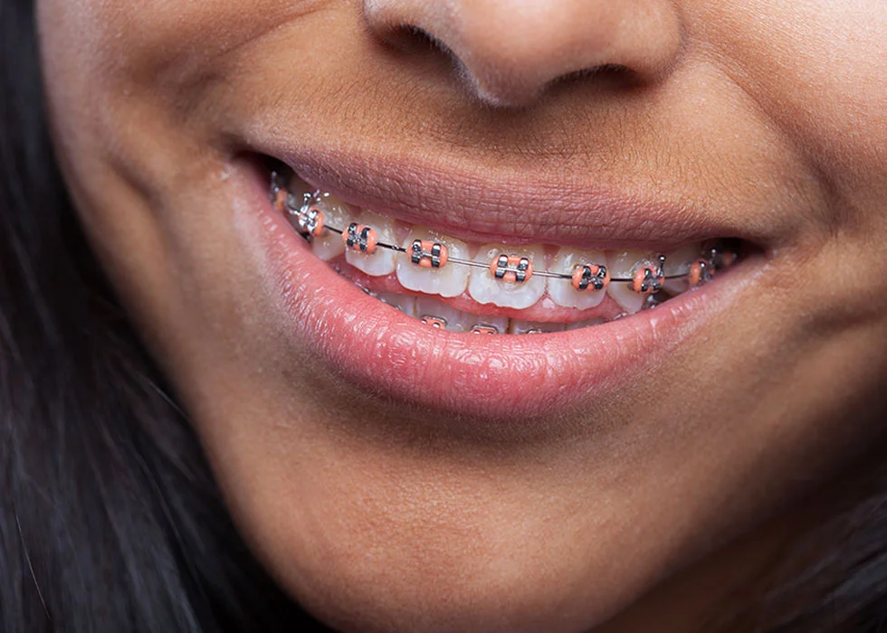 woman braces