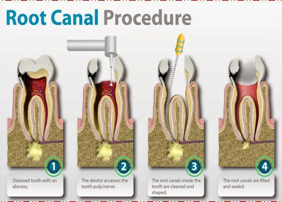 Root canal treatment