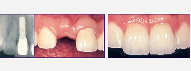 SINGLE TOOTH-DENTAL IMPLANT