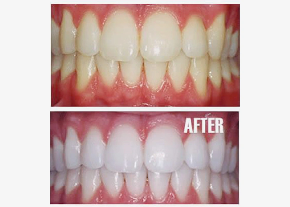 Oral Prophylaxis / Scaling 