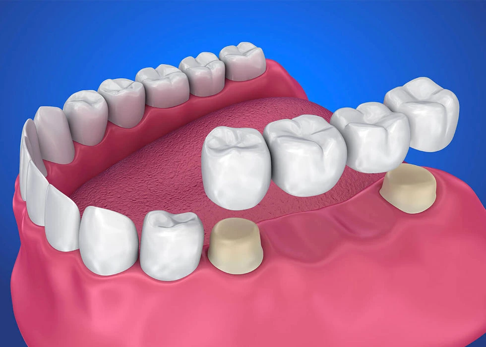 Partial Dentures