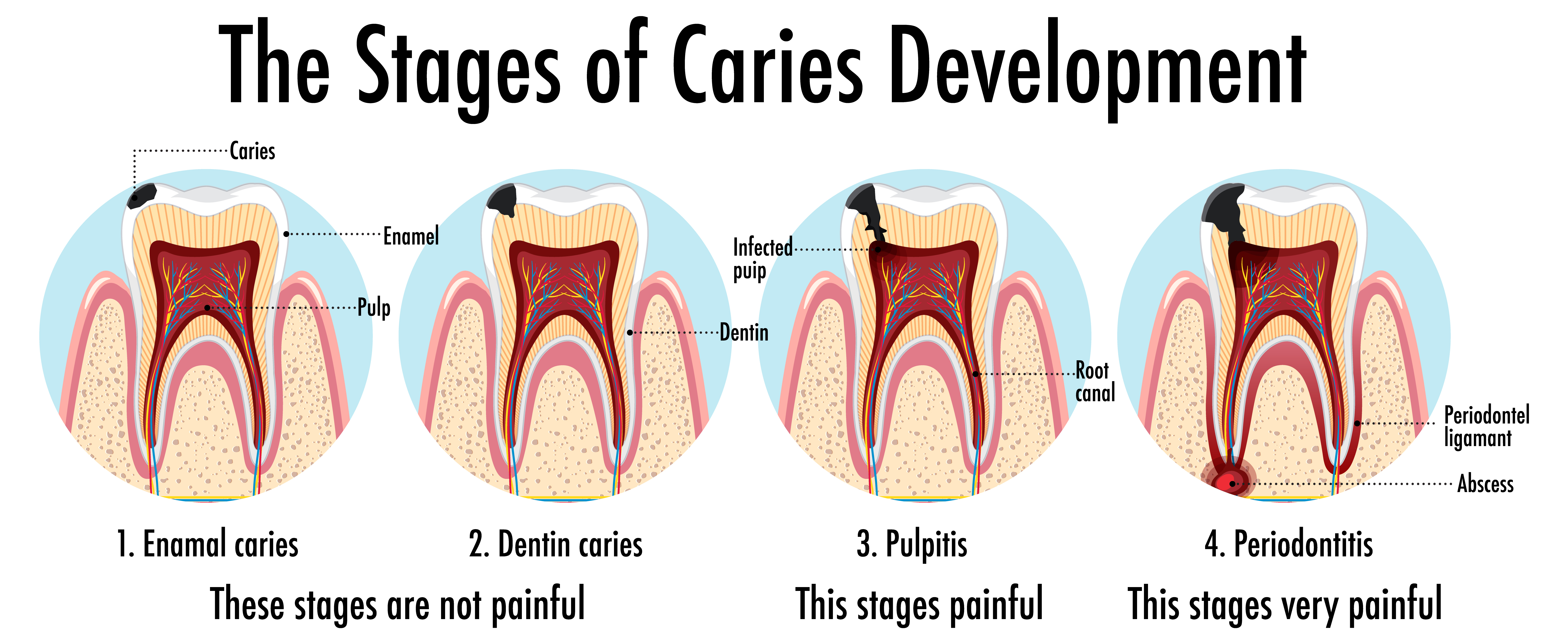 Stages of caries development